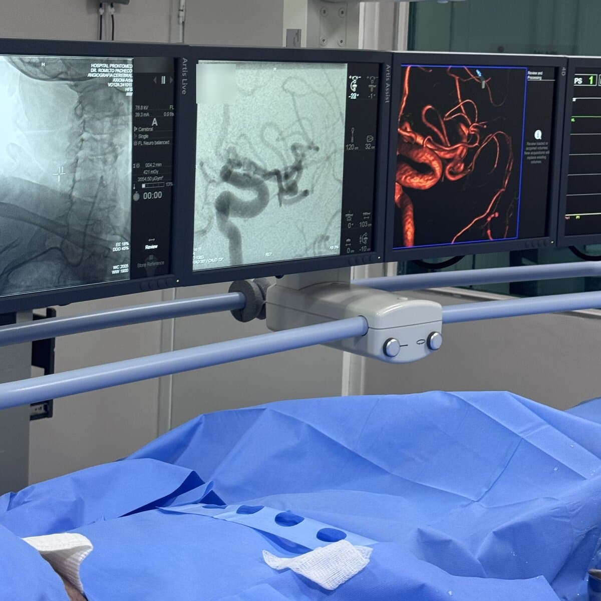 Angiografia Cerebral